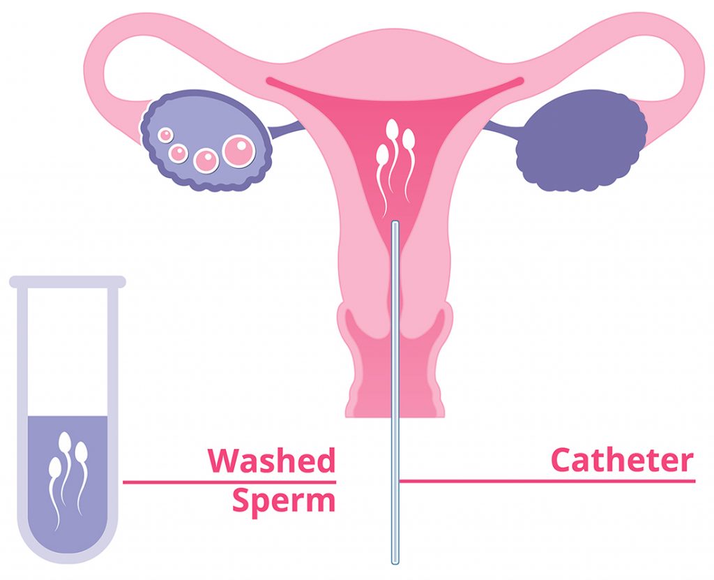 Bơm tinh trùng vào buồng tử cung – Thời điểm nào là phù hợp?