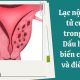 Lạc nội mạc tử cung trong cơ: Dấu hiệu, biến chứng và cách điều trị